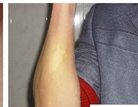 白癜风久治不愈可能是什么原因?