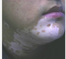 皮肤白斑和白癜风是一回事吗?(
