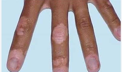 治疗初期白癜风一般要多久才能好?