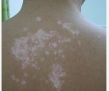 白癜风患者患皮肤癌的概率比其他人高 ?