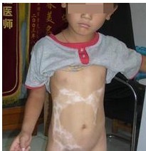 儿童白癜风患者在治疗时应该注意哪些问题 ?
