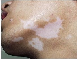 白癜风白斑出现色素岛是病情好转吗?