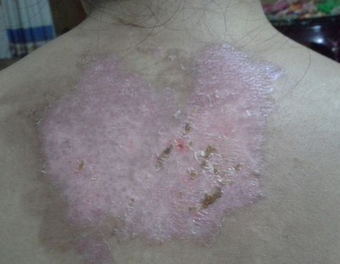 白癜风患者皮肤用药白斑处又红又痒是过敏