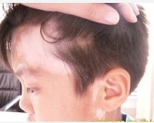 如何判断小孩面部的白斑就是否是白癜风?