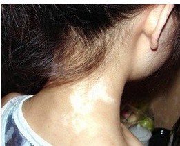 毛囊分布疏密对白癜风治疗有什么影响