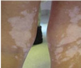 肢端型白癜风发病的原因有哪些?