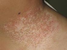 白癜风白斑为什么会扩散?