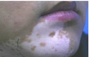 脸上长白癜风跟缺少矿物质有关系吗?