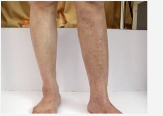 白癜风蓝氧靶向治疗技术可靠吗