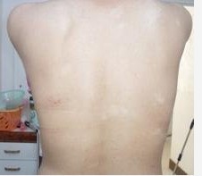 白癜风的前期症状是什么样的?