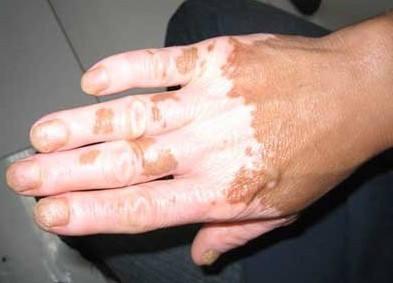 治疗白癜风的方法常用的有几种?