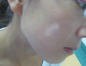 308nm准分子激光治疗面颈部白癜风效果好