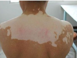 泛发型白癜风的扩散发展有什么特点?