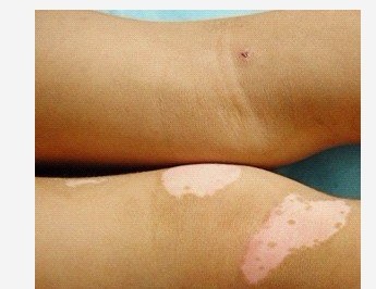 胳膊和腿上的白癜风该怎么治疗