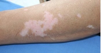 哪种类型的白癜风用激光治疗效果好?