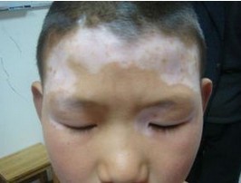 白癜风的危害具体表现在哪些方面