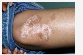 白癜风患者的具体原因是什么