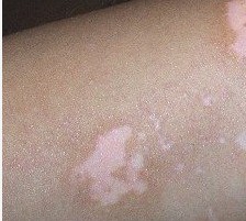 不同情况的白癜风症状有什么不同