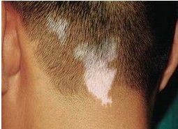 白癜风是怎么引起的?