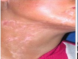 怎样预防白癜风复发