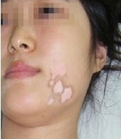 诱发白癜风的原因到底是什么