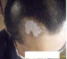 到了冬天还有必要治疗白癜风吗