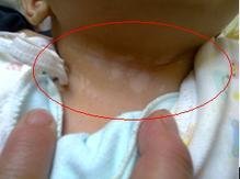 儿童白癜风初期症状有什么?