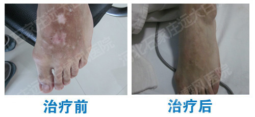 治疗初期白癜风应该注意哪些要点