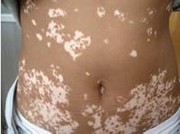 冬天治疗白癜风会有哪些优势