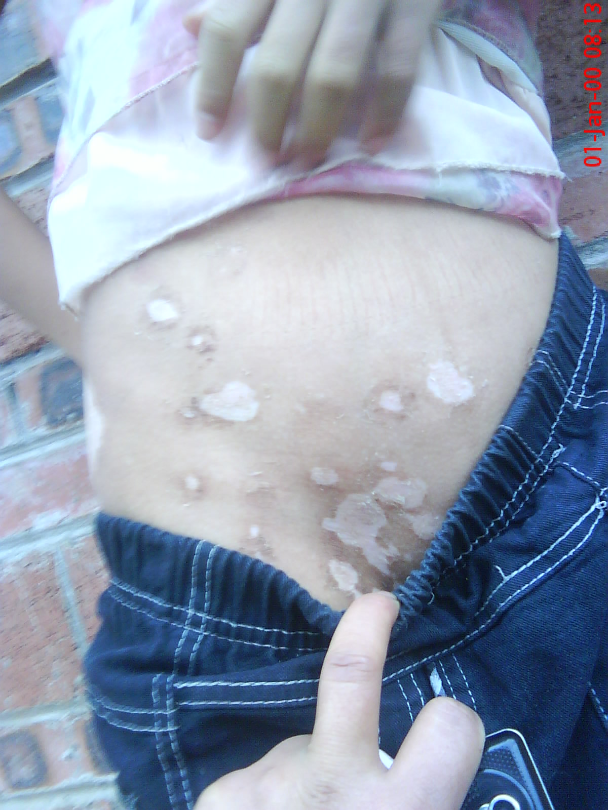 儿童白癜风的早期症状表现是什么