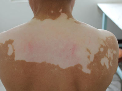 白癜风治疗不及时的后果