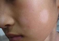 治疗白癜风期间出现新的白斑该怎么办