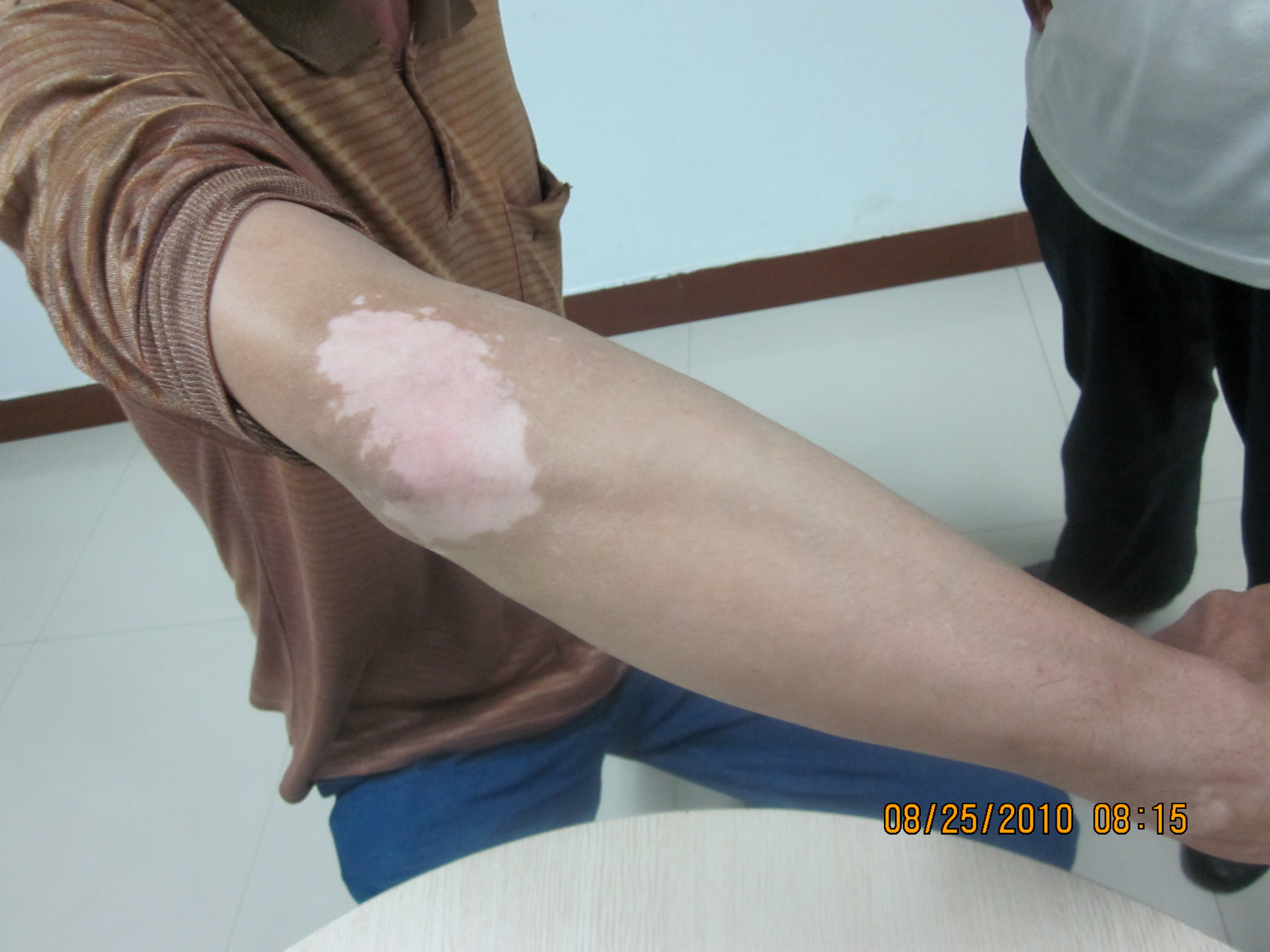 白癜风植皮手术后要多长时间才能恢复