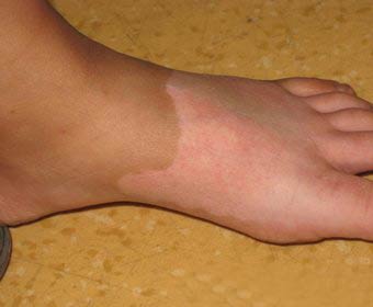 脚上有白癜风是怎么回事