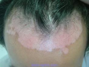 白癜风患者如何进行手术治疗