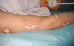 双臂白癜风的初期症状有哪些?