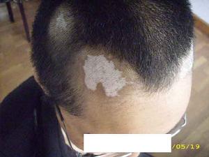 头部白癜风早期症状是怎样的.jpg