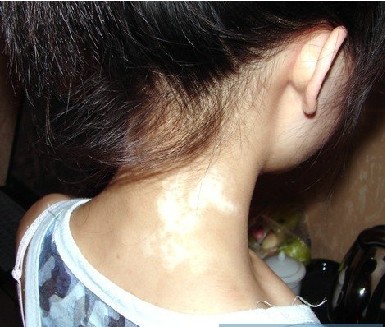 脖子上有白块是怎么回事