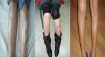 肢端型白癜风怎么治疗效果好