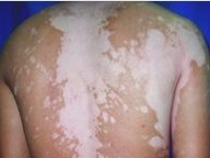 白癜风的治疗原则有哪些