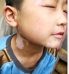 儿童患有白癜风后有哪些发病症状?