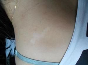 白癜风症状发作前有什么表现