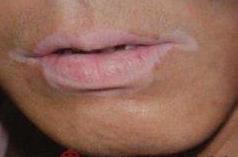 白癜风都有哪些常规诊断方法