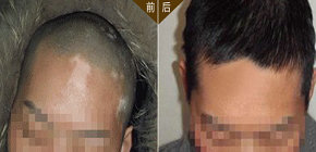 308准分子激光治疗白癜风要多长时间