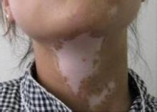 局限性白癜风不治疗的危害有哪些?