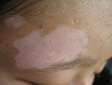 擦外用药后白斑处痒是怎么回事