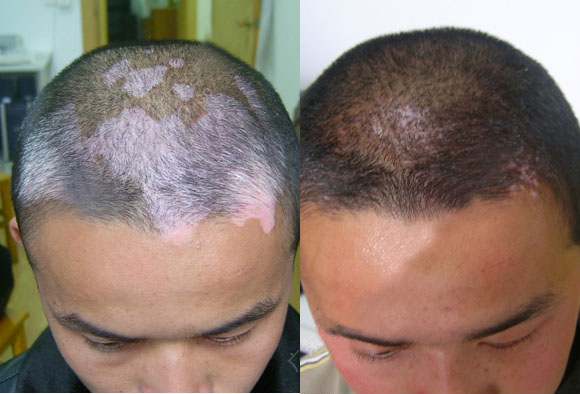 白癜风和白斑病区别是什么