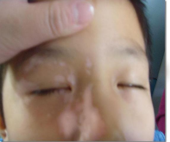 白癜风进入发展其后该怎么控制和治疗