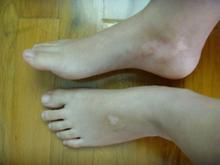 白癜风发病初期有什么明显症状