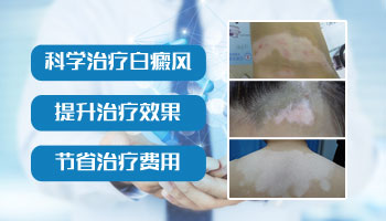 宝宝白癜风应该怎么治疗